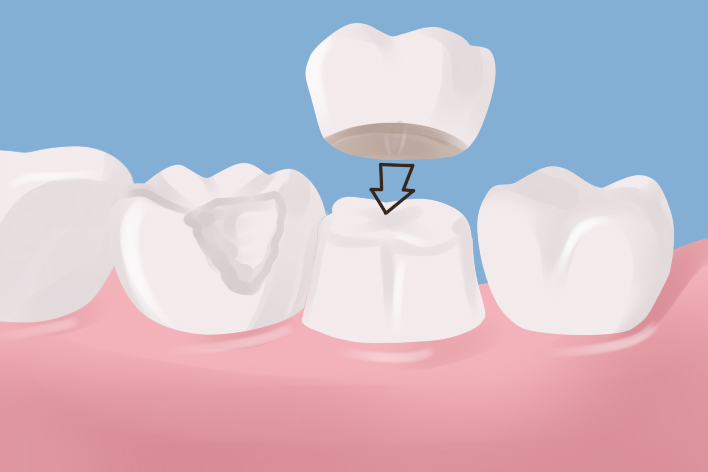 dental crown Waltham