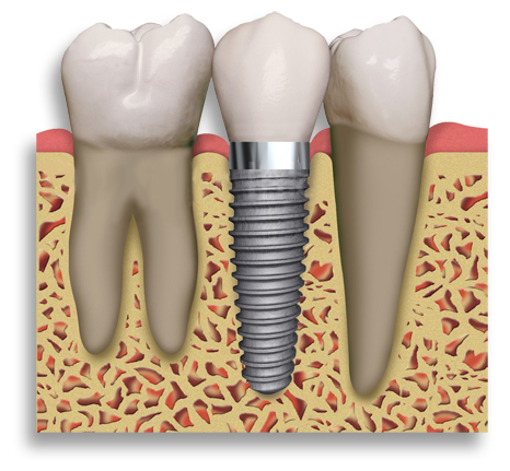 Dental Implants in Waltham