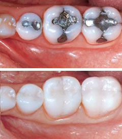 composite and amalgam fillings Waltham